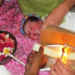 Newborn baby's umbilical cord being burned off