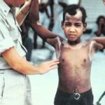 child burnt by nuclear radiation