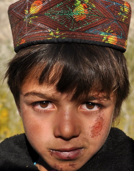 This six-year-old boy tripped and fell on his face two months ago. Health services in the area are poor. The Afghan government has promised to build a health clinic in the area, but it is yet to deliver.