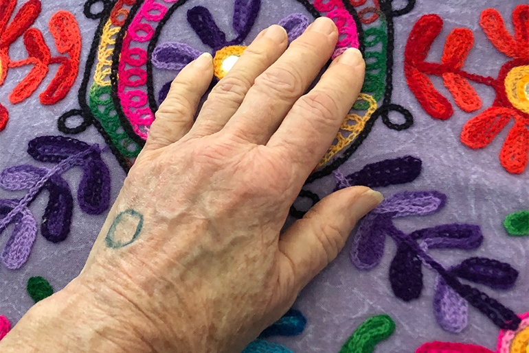 Spot marked on hand